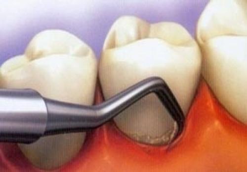 درمانی جدید برای ترمیم دندان‌های آسیب دیده