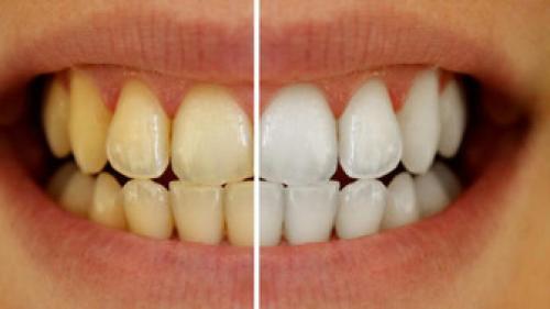 ۶ راه طبیعی سفید کردن دندان‌ها 