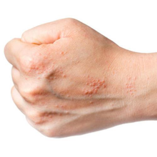  اگزمای پوستی ربطی به کمبود ویتامین در بدن ندارد 