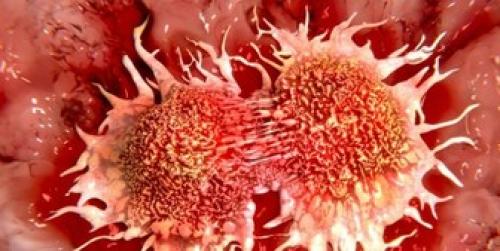  آهن، قاتل سلول‌های سرطانی 