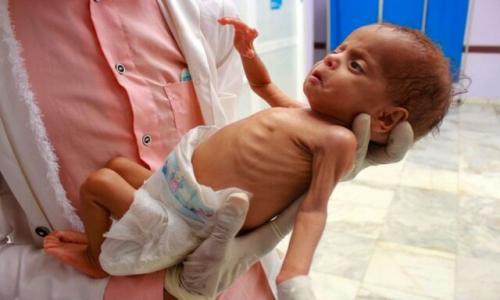 "خانواده‌های یمنی در معرض قحطی و گرسنگی"