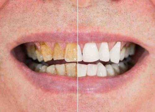 6 روش طبیعی جرم‌گیری دندان در منزل 