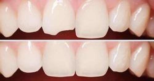  ۸ روش درمان شکستگی دندان