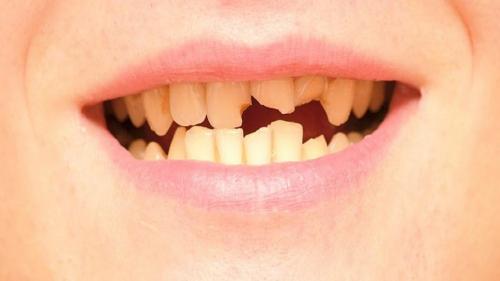  ۸ روش برای درمان ترک خوردگی و شکستگی دندان
