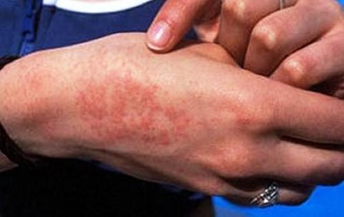 ۷۶ مورد ابتلا به تب مالت در شیروان گزارش شد