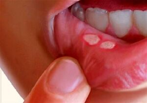 آفت دهان چیست؟ علایم و درمان