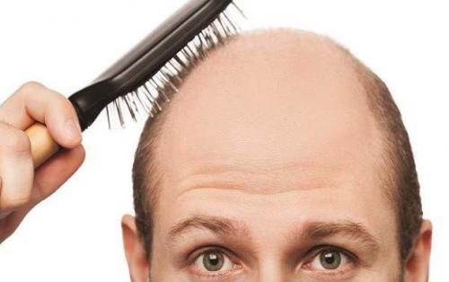 تفاوت‌های ریزش مو در زنان و مردان