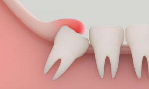 کشیدن دندان عقل ضروری است؟