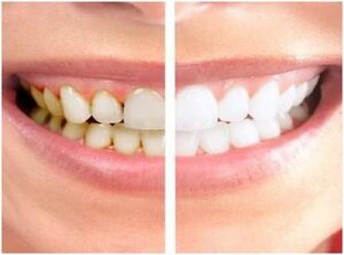 روش‌های خلاصی از شر جرم دندان 