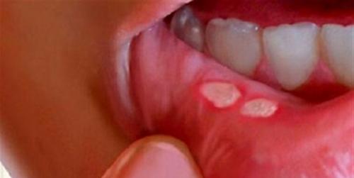  آیا آفت دهان کودکان خطرناک است؟ 