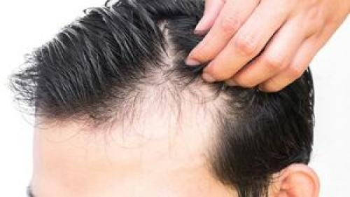  علت افزایش ریزش مو چیست؟