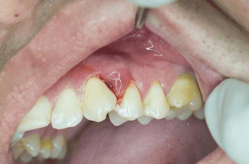  عفونت دندان یا آبسه و روش‌های درمان آن