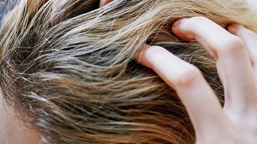  درمان چربی مو در طب سنتی + فیلم