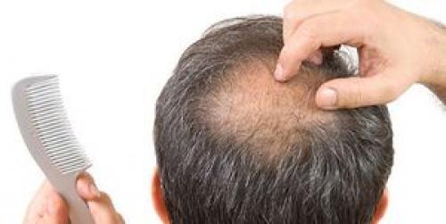  ریزش مو در دوران کرونا و درمان آن