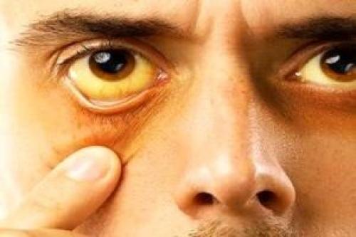لکه زرد در چشم نشانه چیست؟