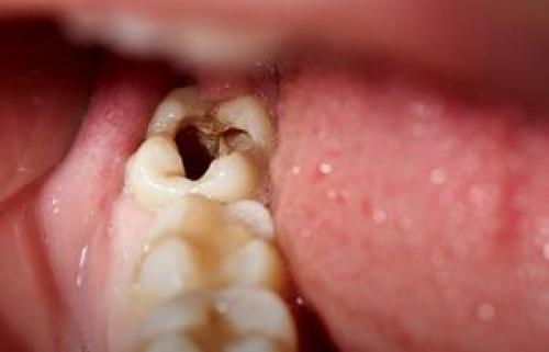 چرا برخی دندان‌ها زودتر خراب می‌شوند؟