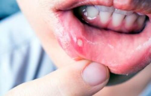 دلایل ایجاد آفت در دهان چیست؟