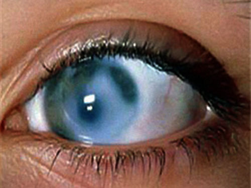 بیماری چشمی آب‌سیاه چه علائمی دارد؟