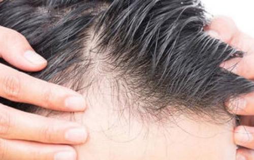 ۶ دلیل که باعث ریزش موها می‌شود
