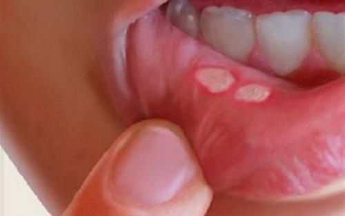 درمان آفت دهان با چند راهکار طب سنتی