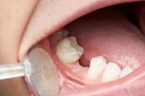 راه‌های کاهش پوسیدگی دندان