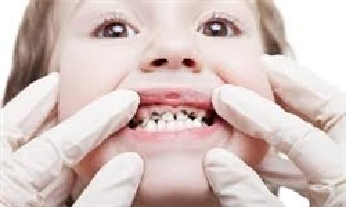 عواملی که سبب پوسیدگی دندان می شود