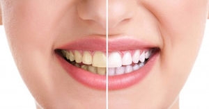  همه چیز درباره جرم گیری دندان‌