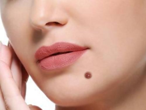  ۴ نشانه خال‌های خطرناک 