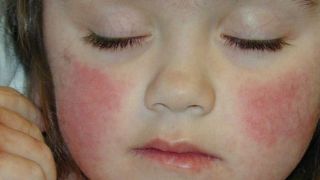 علت سرخ شدن پوست صورت چیست؟ 