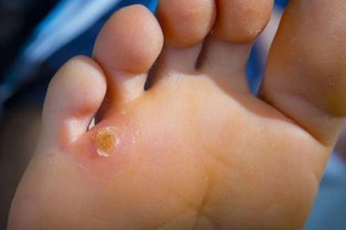 نسخه طب سنتی برای درمان میخچه وپینه 