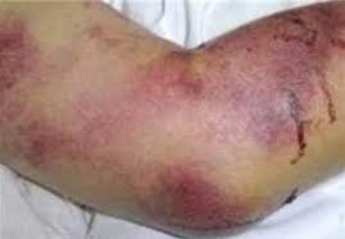  تب کریمه کنگو جان ۱۰ نفر را گرفت 
