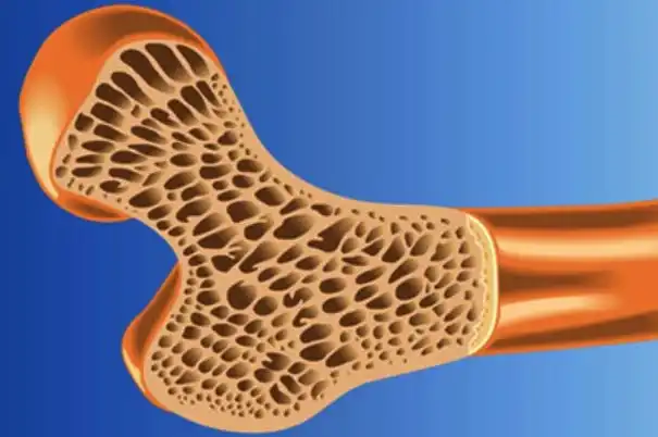 عوامل ایجاد پوکی استخوان در افراد