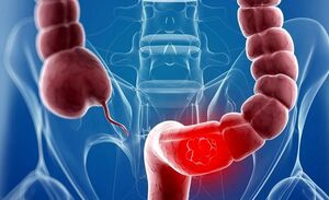 افزایش ریسک زوال عقل با بیماری کولیت روده