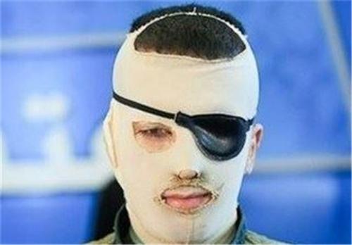 سرنوشت مبهم تشدید مجازات اسیدپاشی 