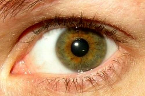  قرمزی چشم از علائم ابتلا به کرونا است 