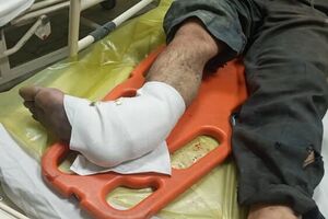موادمحترقه باعث قطع پای مرد ساوجی شد