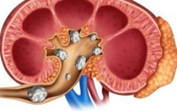 چطور سنگ کلیه نگیریم؟