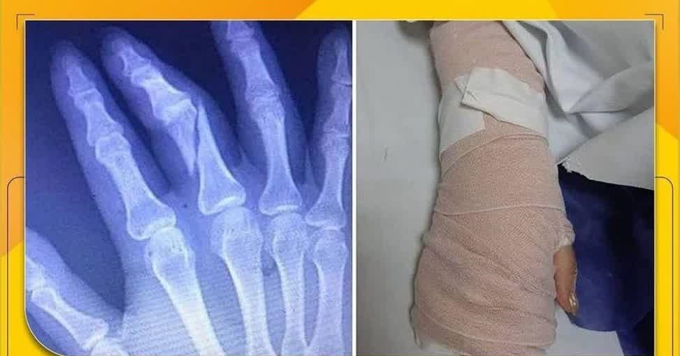 عکس/ دست خانم خبرنگار را شکستند