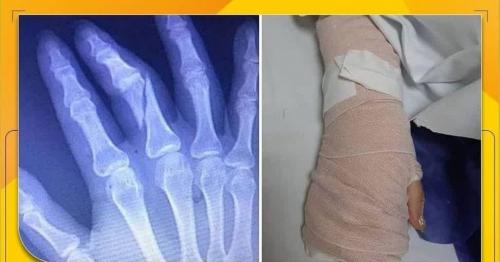 عکس/ دست خانم خبرنگار را شکستند