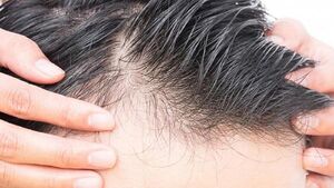 آیا ریزش موی ناشی از کرونا دائمی است؟