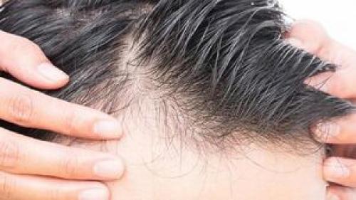 آیا ریزش موی ناشی از کرونا دائمی است؟