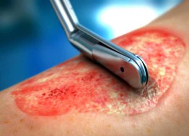 راهکار بهبود سریع زخم دیابتی