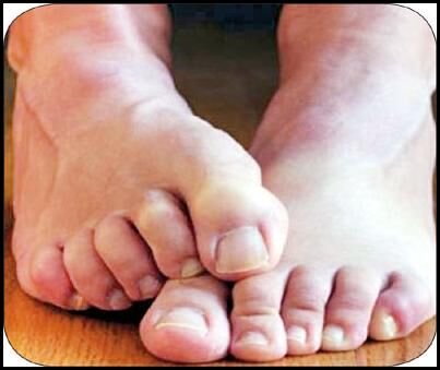 متخصص مغز و اعصاب:احساس حرکت مورچه در پا به سندرم پای بیقرار مربوط است