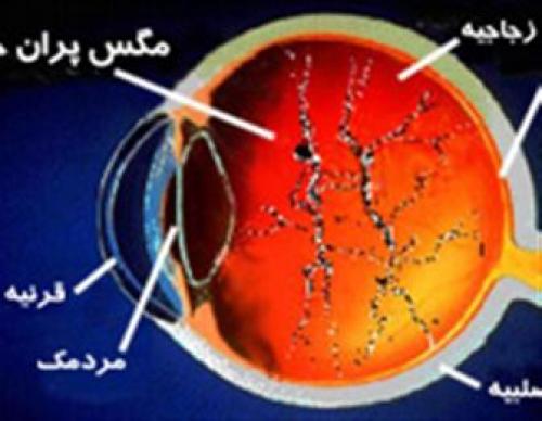 بیماری مگس پران چشم چیست ؟