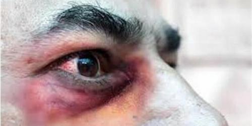  بیماری قارچ سیاه یک عفونت قارچی جدی است
