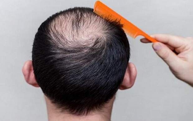یک نوشیدنی تلخ برای مبارزه با ریزش مو