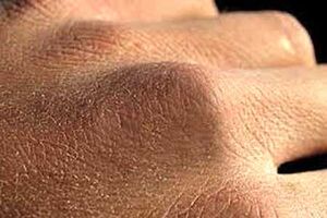 تاثیر برخی خوراکی‌ها بر رنگ پوست