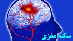  اینفوگرافیک/ چگونه سکته مغزی را تشخیص بدهیم؟