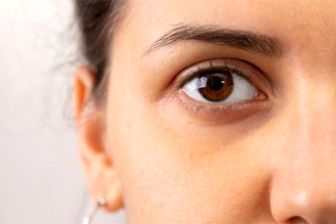  برای رفع گودی چشم چه کارهایی انجام دهیم 