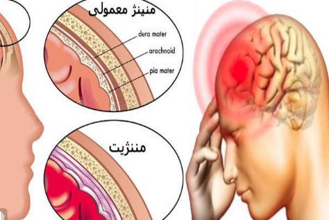  مننژیت چیست؟